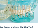 Are Dental Implants Right for You?