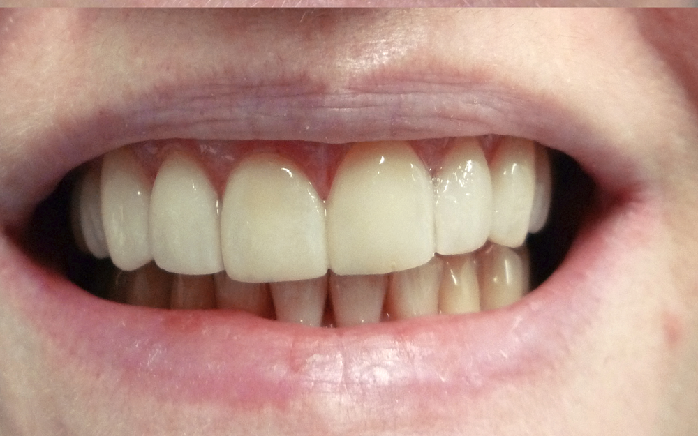 Patient sparkling white teeth after aesthetic dental whitening treatment