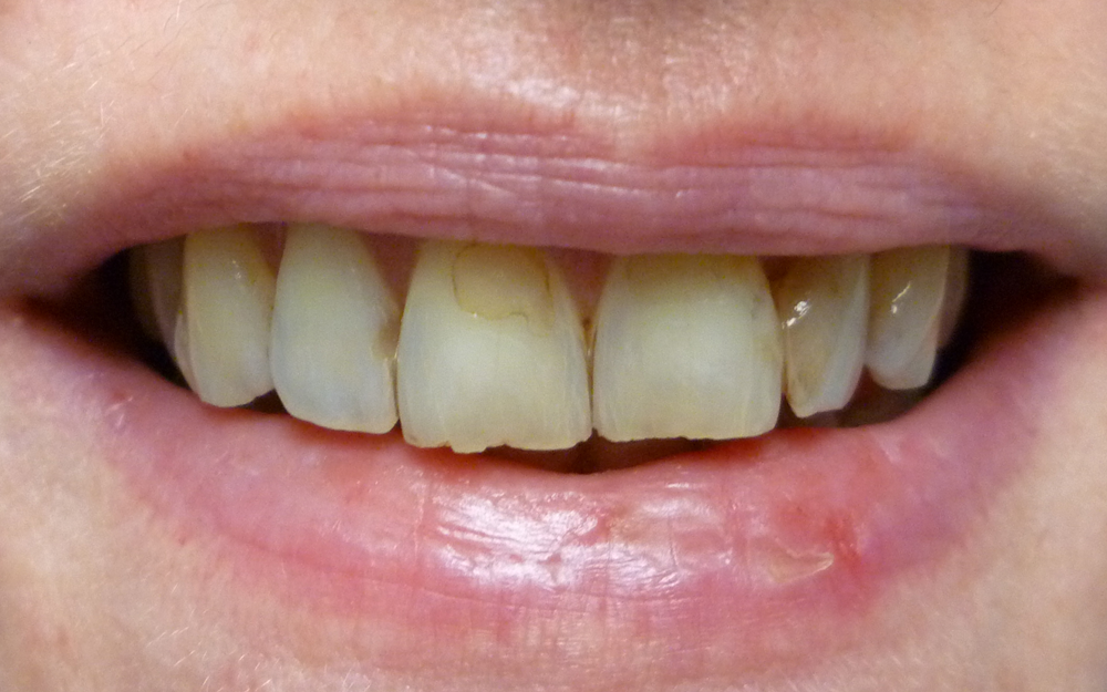 Patient teeth before aesthetic dental treatment
